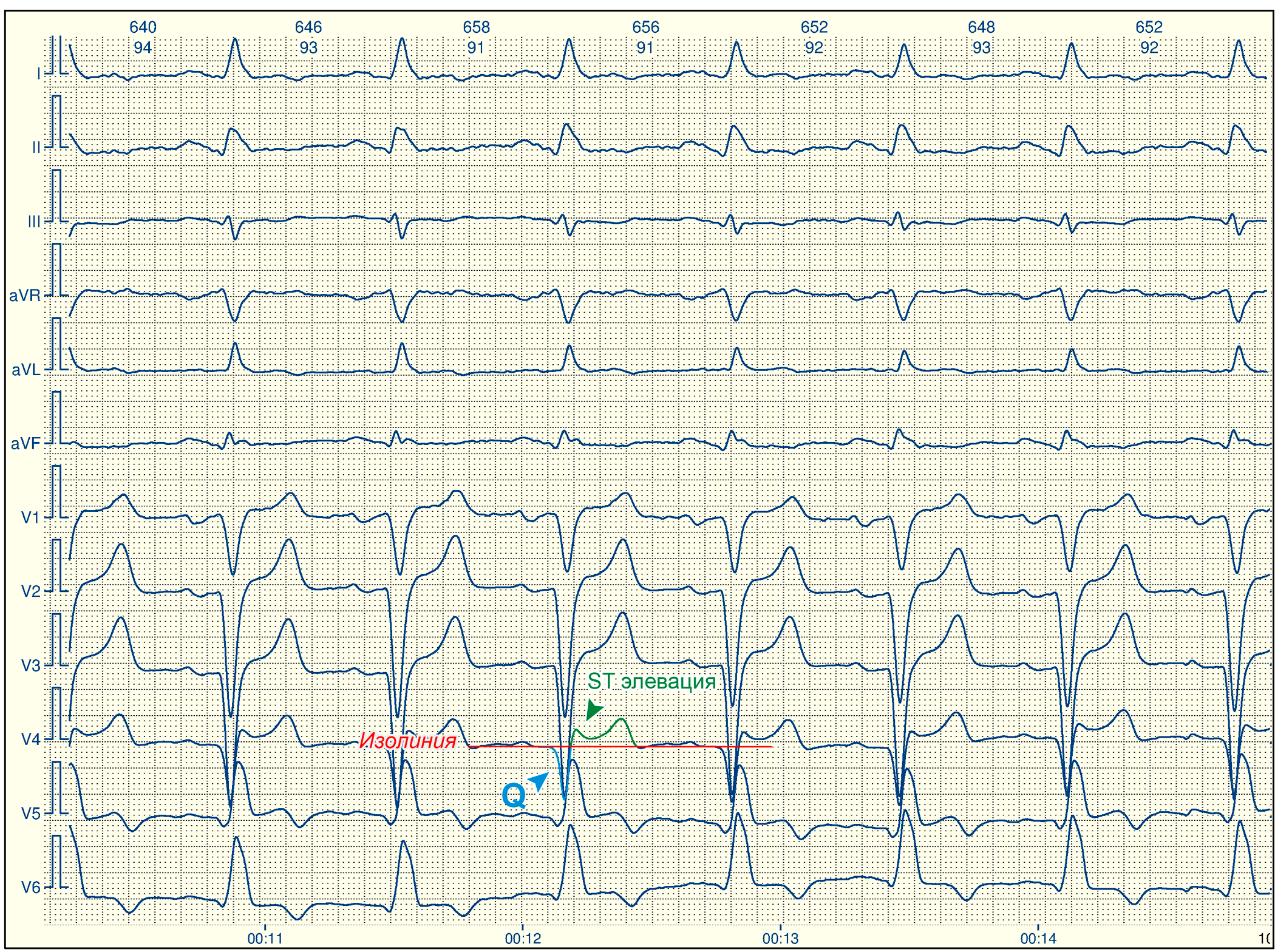Рубцы на сердце на экг что это. Изолиния на ЭКГ. Паттерн Аслангери на ЭКГ. ЭКГ рубцовые изменения передне-перегородочной. Изоэлектрическая линия на ЭКГ это.